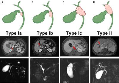 Cystic Duct Carcinoma: A New Classification System and the Clinicopathological Features of 62 Patients